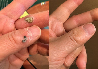 PURESHADE® 2v1 mikrojehličková + hydrokoloidní náplast🍀 | Pomáhá odstraňovat vystouplá znaménka, akné, ploché bradavice a kožní výrůstky | Pomáhá zjemnit vrásky, jizvy a nedokonalosti pleti | Diskrétní neviditelná náplast pro obličej i tělo