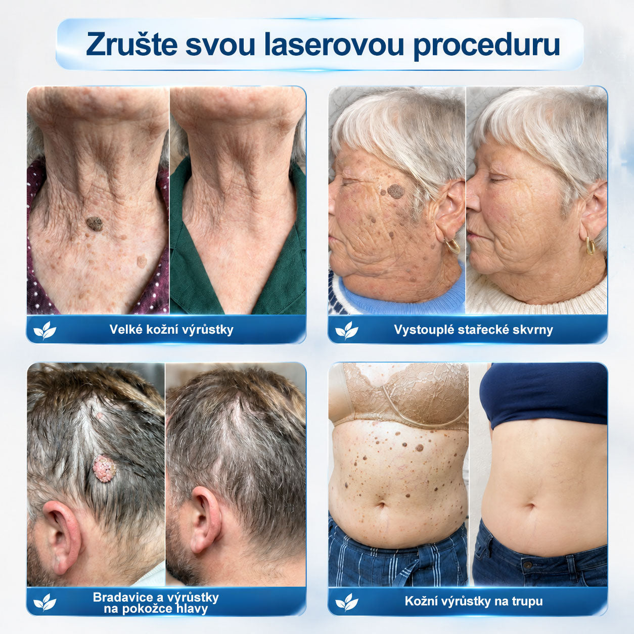 Oficiální značkový obchod | 🐬🐬🐬Hiskin® 7denní odstraňovač skvrn a pigmentových skvrn (Bezbolestný rollerball bez jizev)