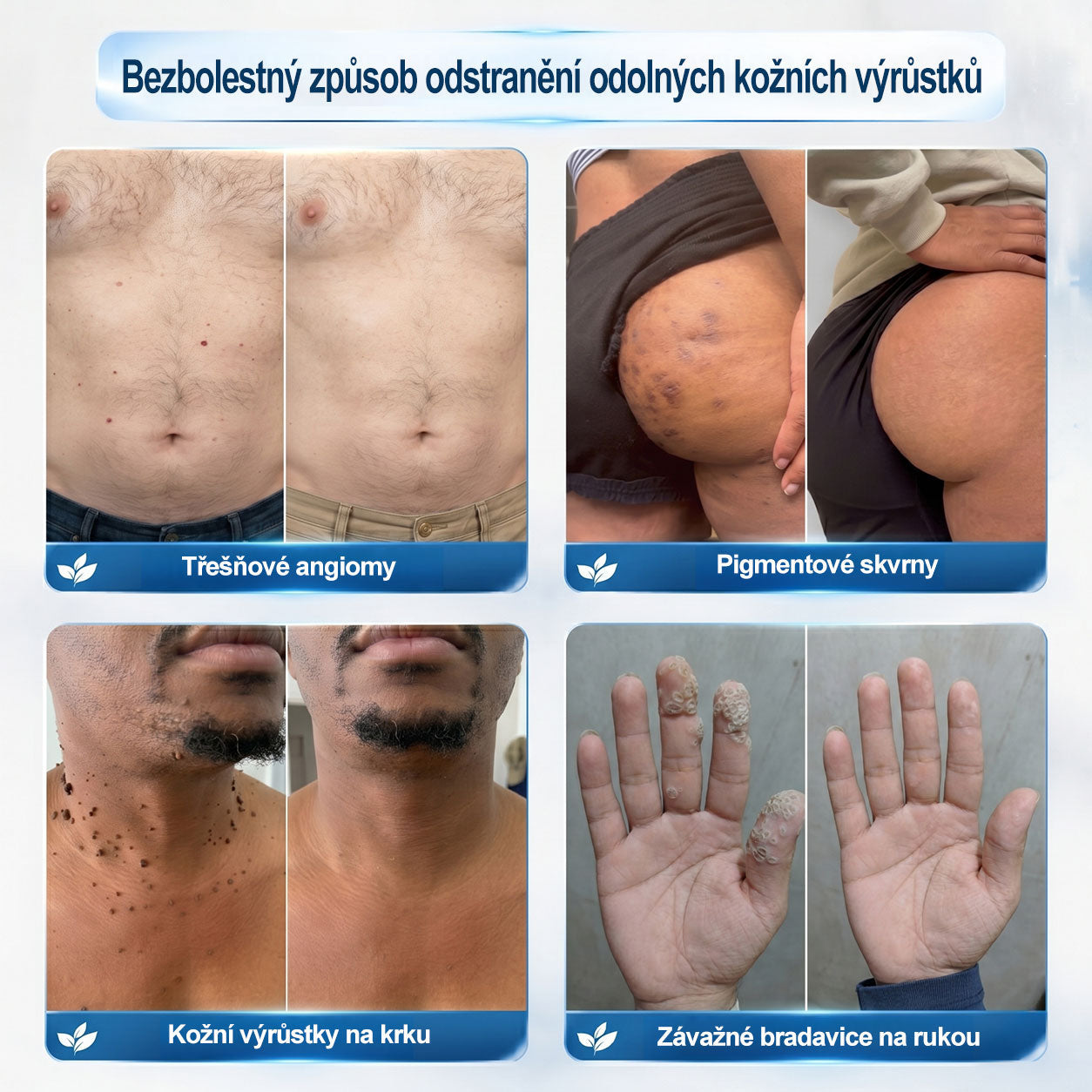 Oficiální značkový obchod | 🐬🐬🐬Hiskin® 7denní odstraňovač skvrn a pigmentových skvrn (Bezbolestný rollerball bez jizev)