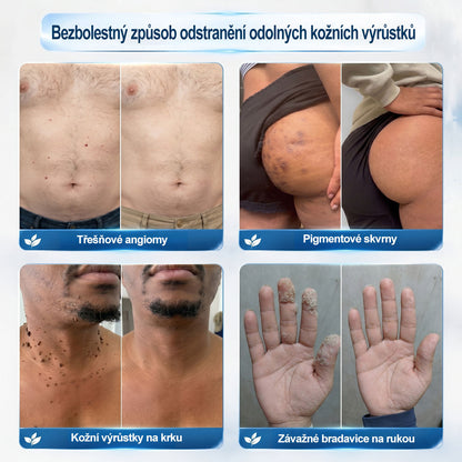 Oficiální značkový obchod | 🐬🐬🐬Hiskin® 7denní odstraňovač skvrn a pigmentových skvrn (Bezbolestný rollerball bez jizev)