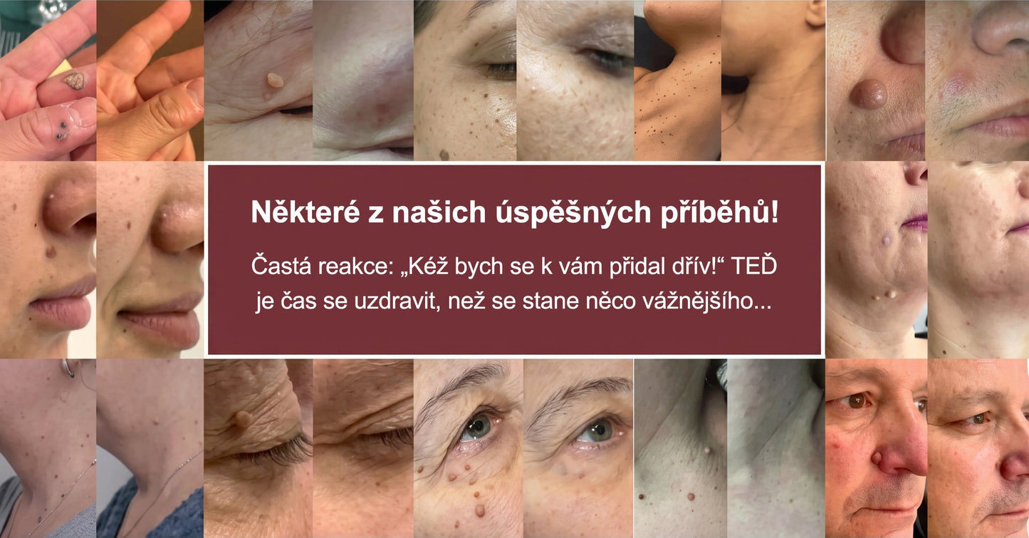 PURESHADE® 2v1 mikrojehličková + hydrokoloidní náplast🍀 | Pomáhá odstraňovat vystouplá znaménka, akné, ploché bradavice a kožní výrůstky | Pomáhá zjemnit vrásky, jizvy a nedokonalosti pleti | Diskrétní neviditelná náplast pro obličej i tělo