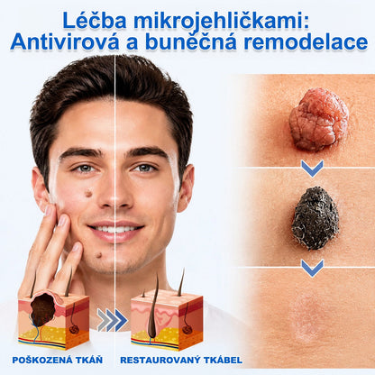 PURESHADE® 2v1 mikrojehličková + hydrokoloidní náplast🍀 | Pomáhá odstraňovat vystouplá znaménka, akné, ploché bradavice a kožní výrůstky | Pomáhá zjemnit vrásky, jizvy a nedokonalosti pleti | Diskrétní neviditelná náplast pro obličej i tělo