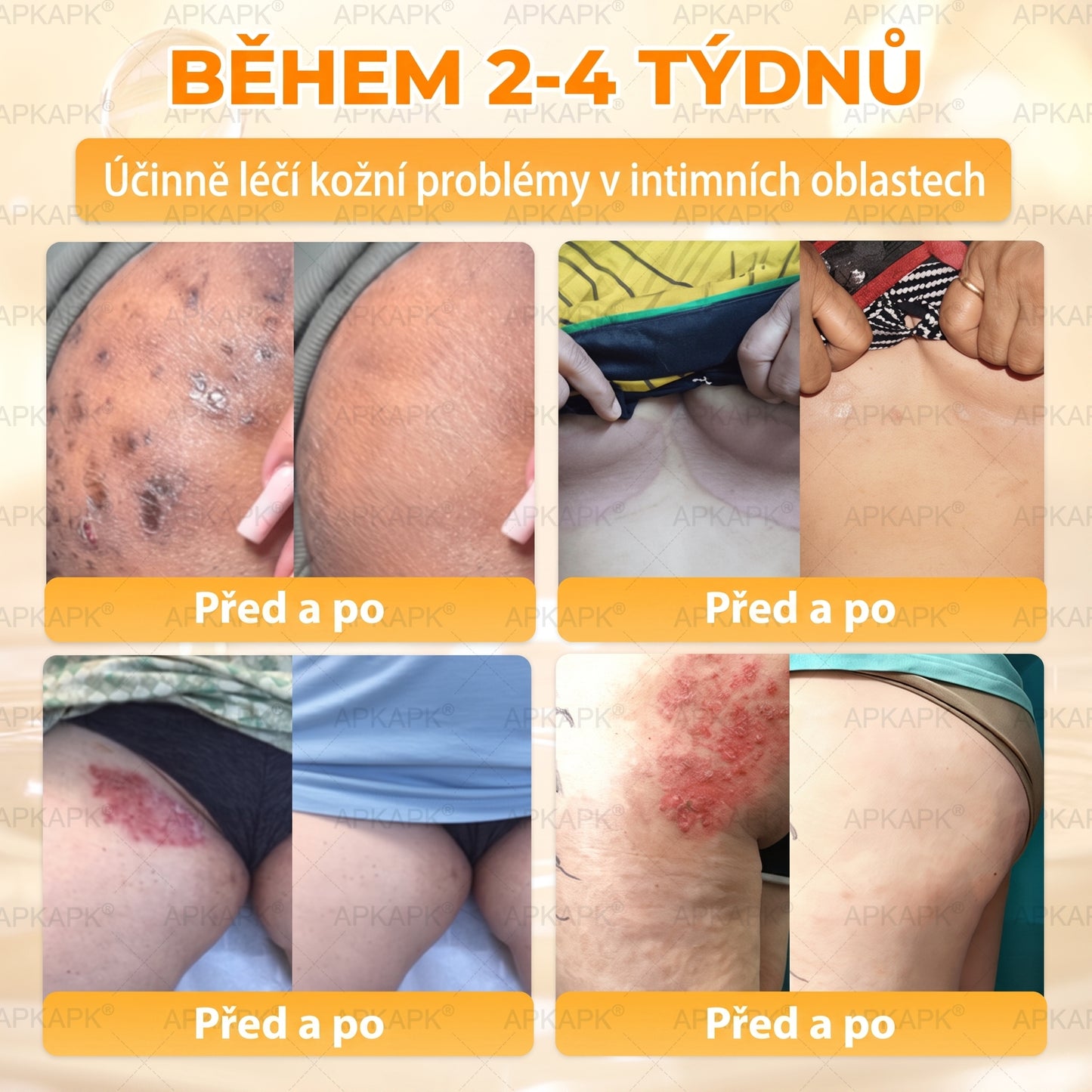𝖠𝖯𝖪𝖠𝖯𝖪® Krém s včelím jedem na obnovu pokožky 🐝🐝 pomáhá při řešení kožních problémů, jako jsou: vrásky, jizvy, pigmentové skvrny, strie, akné, lupénka, ekzém, kožní léze, podráždění, záněty a další kožní potíže.
